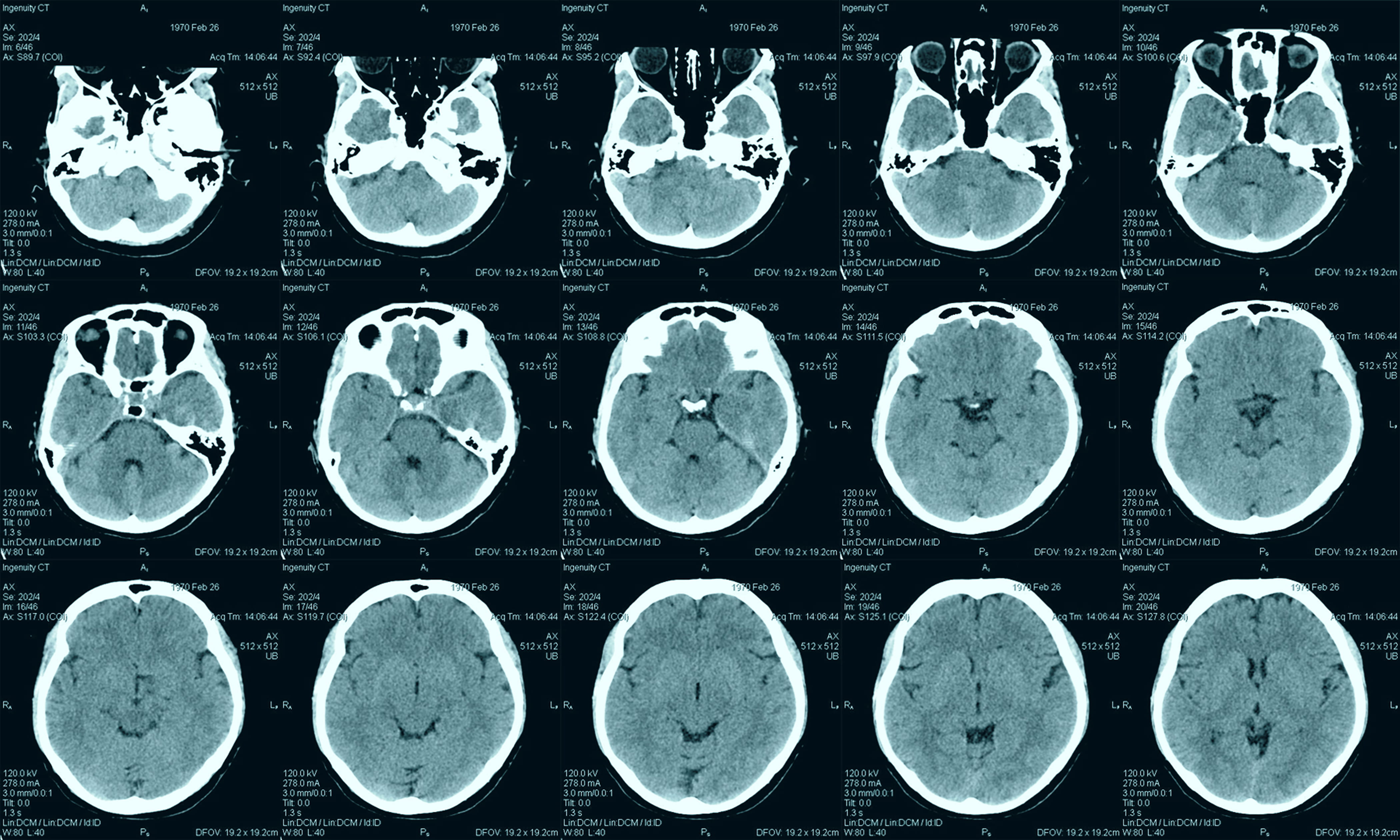 Brain CT scan imaging